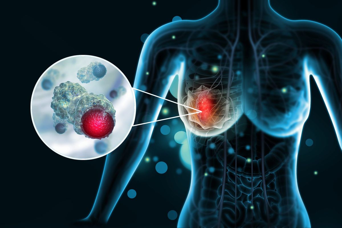 SURGERY FOR BREAST CANCER IS NOT ABOUT REMOVING BREASTS, ALWAYS
