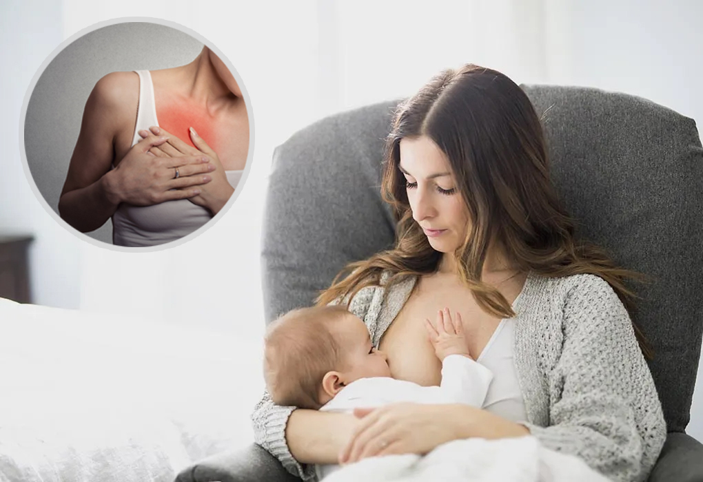 Breast feed you must, but what about that lump in the breast?