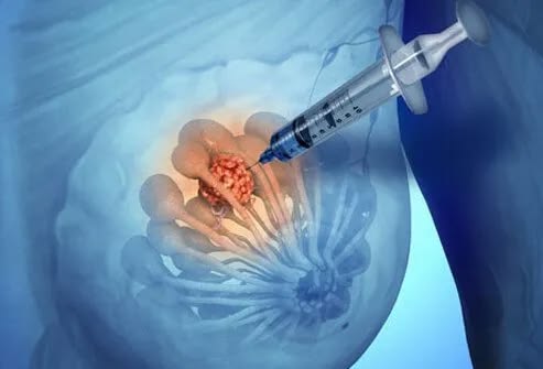SLNB Biopsy